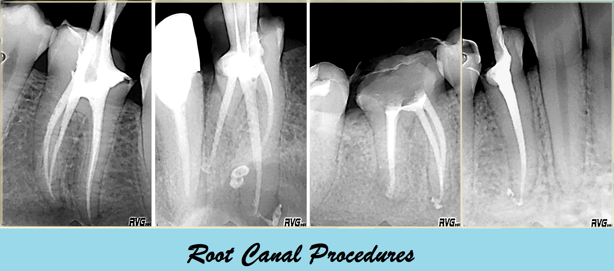 Root Canal Treatment | Our Services Old | Smartoral Dental Practice